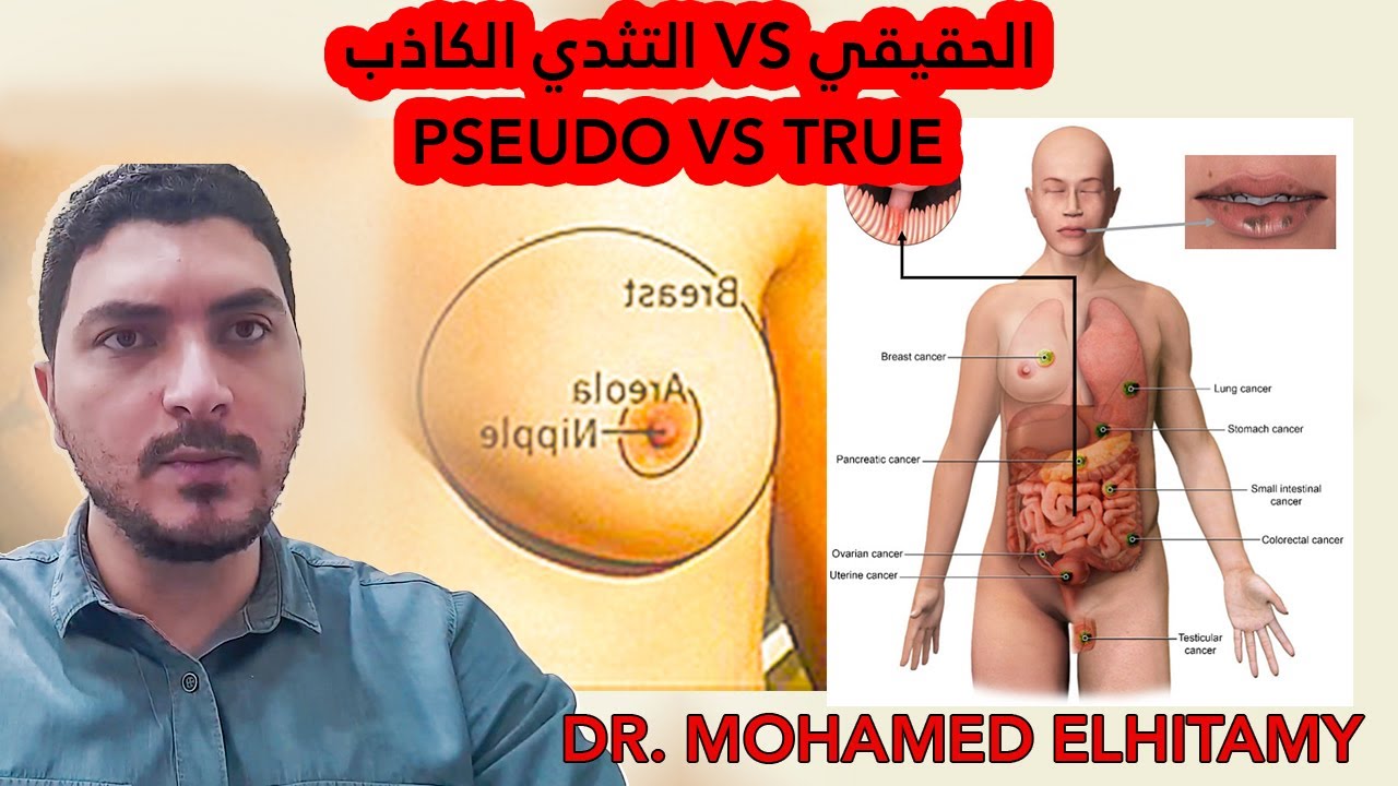 التثدي الكاذب vs التثدي الحقيقي | How to Differentiate Between Pseudogynecomastia, True Gynecomastia