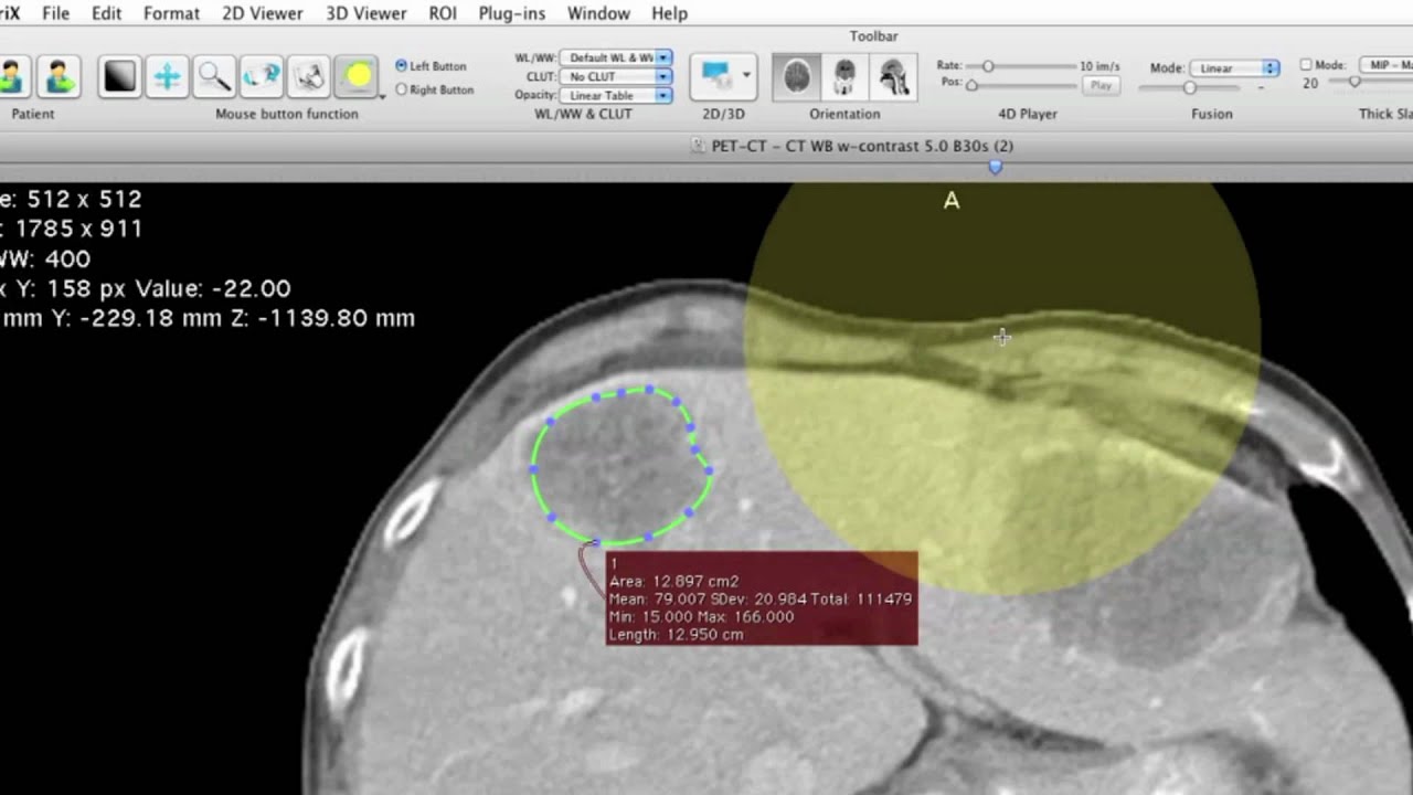 about osirix md