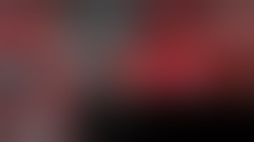 New Trend in Ridge Augmentation: Osseodensification | Edouard Choufani