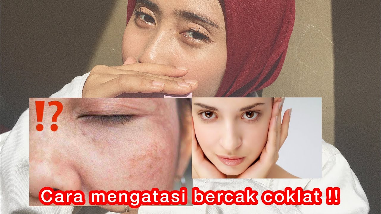 cara-menghilangkan-bercak-coklat-di-wajah-kenali-apa-itu-melasma