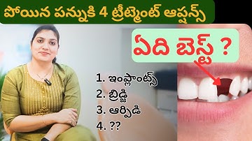 4 Best Tooth Replacement Options | Replace Missing Tooth | Dental Implants | Bridge | Dentures