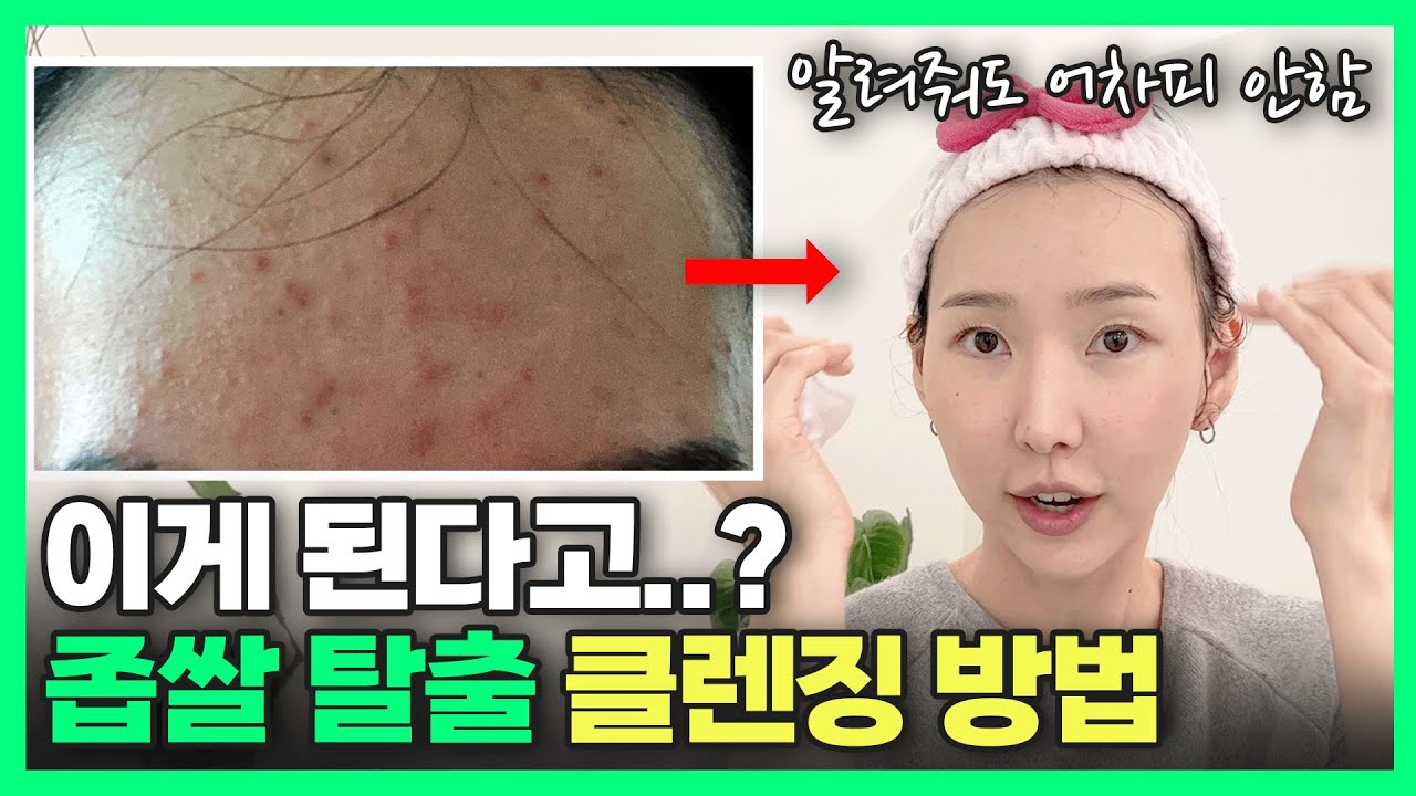 이걸 몰라서 여드름이 생기는 겁니다😱ㅣ알려주기 아까운 좁쌀 여드름 클렌징 방법!