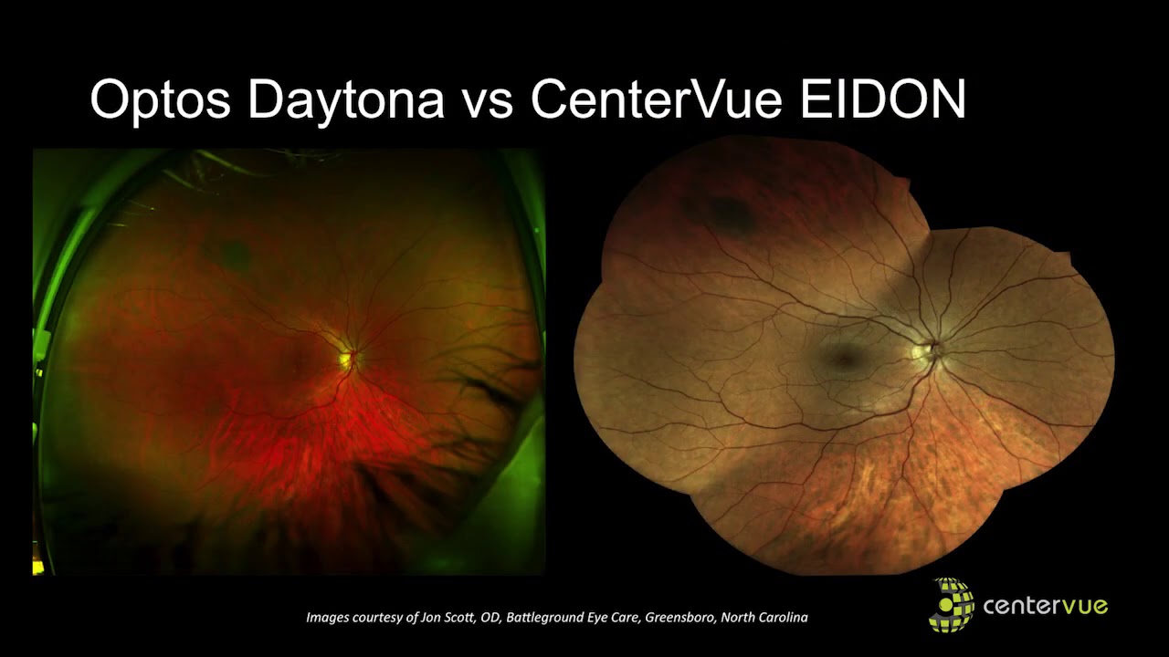 Enhancing Retinal Evaluation and Expediting Workflow with iCare EIDON