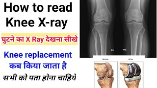 Knee (घुटने) का X ray कैसे देखते है-knee replacement की जरूरत कब पड़ती है -knee joint x ray in hindi screenshot 4