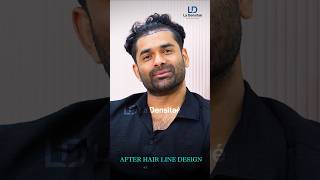 Actor & Model Salman Dhaulath choose La Densitae Clinic for his Hair Transplant Surgery.