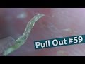 #59 Pull Out Blackheads Close up - Blackheads Removal
