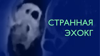 Странная эхокардиограмма #shorts Предположения пишите в комментарии!