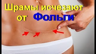Удаление и Лечение шрамов и рубцов фольгой -это невероятно. Шрамы исчезают от фольги. А ты это знал? видео Фольга для рассасывания шрамов, устранения боли
