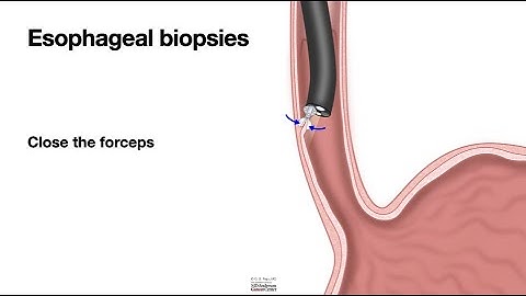 HCC 1475-16a-Biopsy forceps application