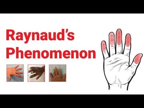 Raynaud&rsquo;s Phenomenon :- Causes and Types, Clinical Features, Diagnosis and it&rsquo;s Management