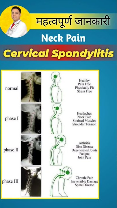 Cervical Spondylitis Kya Hota Hai #shorts #physiodrdeepaksoni