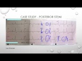 12 lead ecg episode 6  posterior stemi