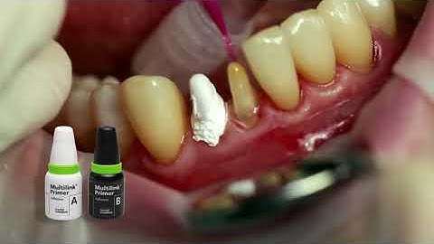 IVOCLAR - Multilink Automix: Cementazione di corone IPS.e max Press