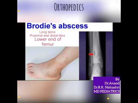 Video: Bilateral Tibial Brodys Abscess Hos En Ung Pasient Behandlet Med BAG-S53P4: Saksrapport
