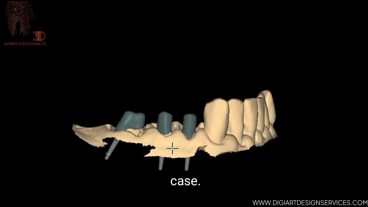 Watch a finished case of Post and core for a dental laboratory