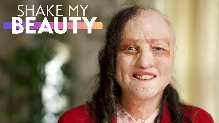 I Suffered 65% Burns When I Was 1 | SHAKE MY BEAUTY