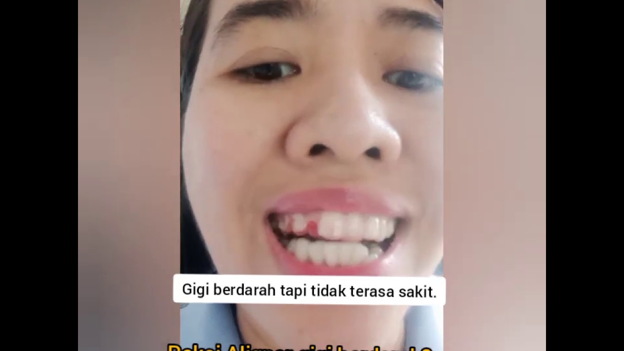 Rata id Pakai Aligner gigi  berdarah YouTube