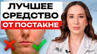 Забудьте про пятна и РУБЦЫ после прыщей! / Как ИЗБАВИТЬСЯ ОТ постакне на лице навсегда?