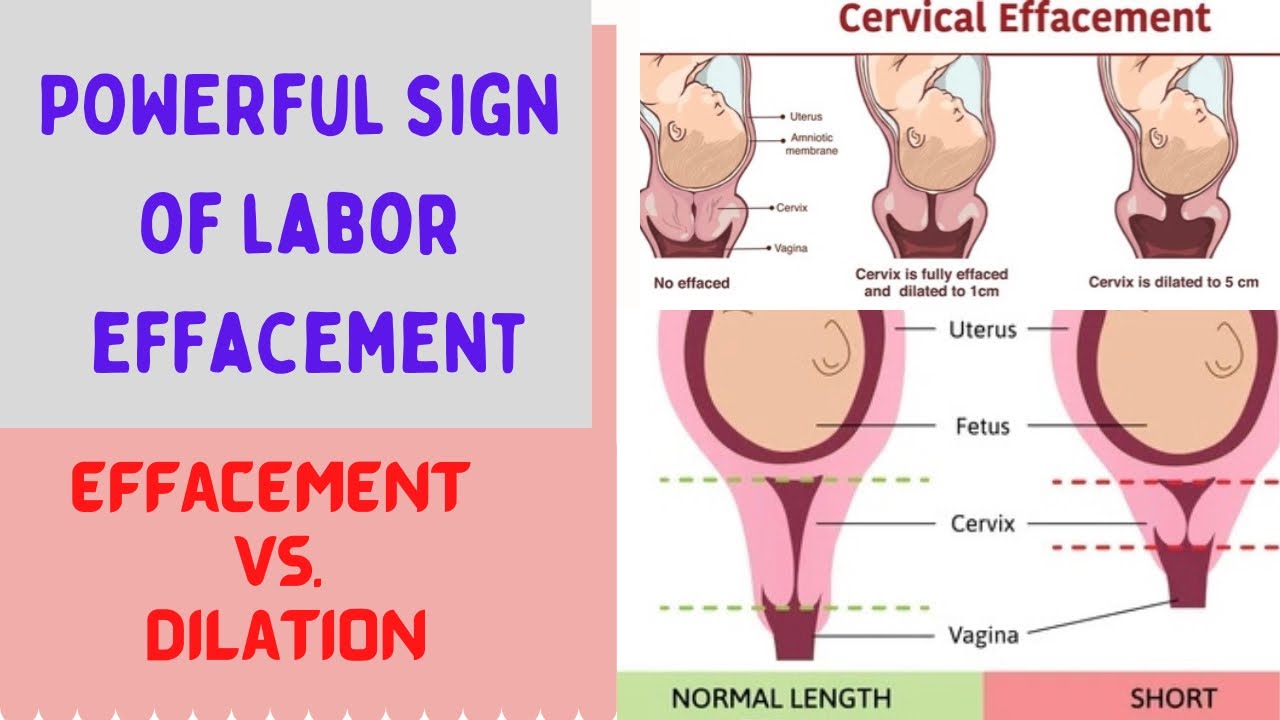 Effacement Testing HOW TO KNOW POWERFUL SIGN OF LABOR | EFFACEMENT VS. DILATION | THE ROLE ...