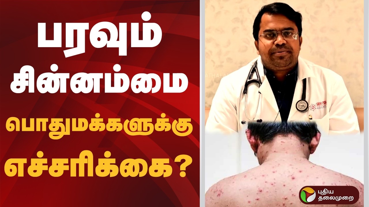 பரவும் சின்னம்மை.. பொதுமக்களுக்கு எச்சரிக்கை? | #chickenpox  | #doctoradvice | #ptd