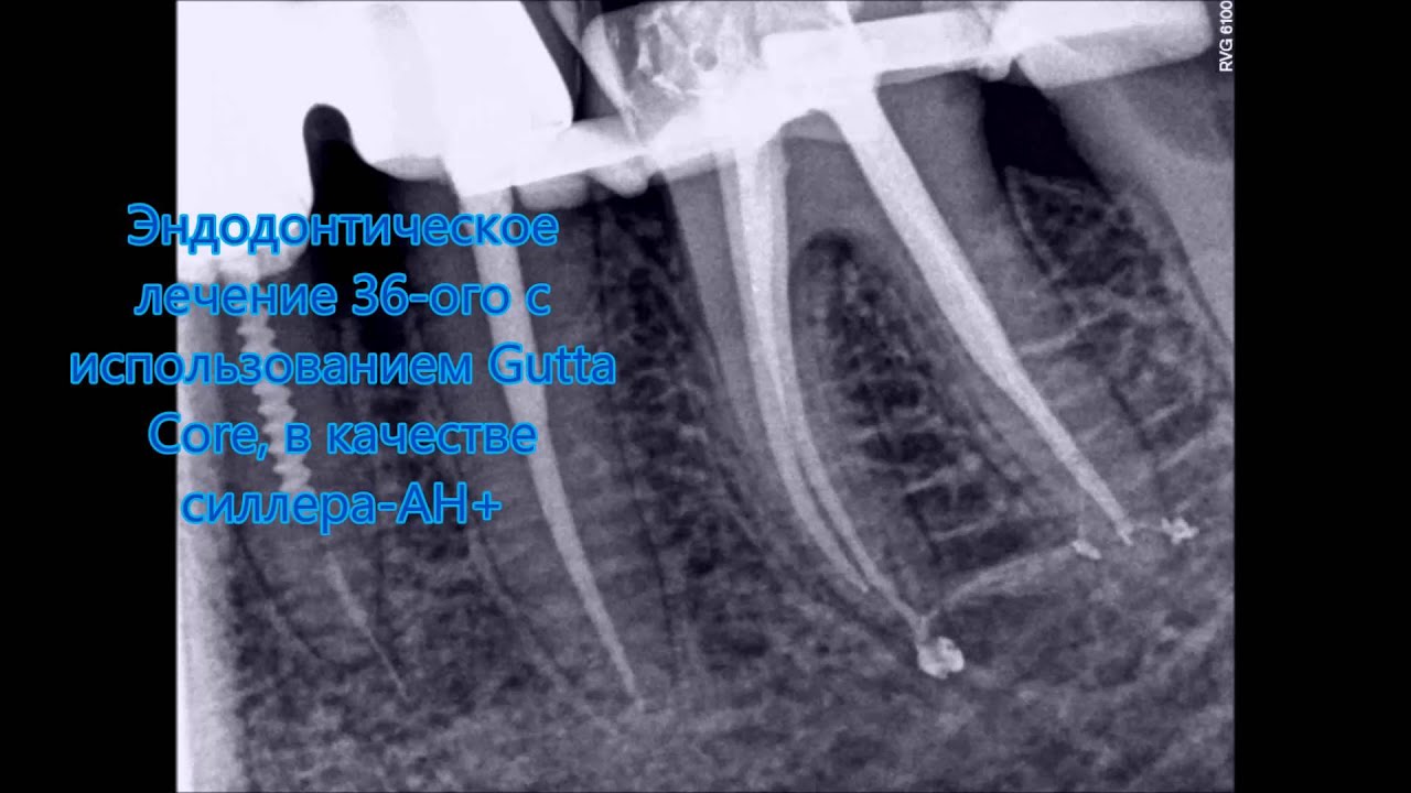 После эндодонтического лечения. Пломбирование каналов зубов. Эндодонтическое лечение. Эндодонтическое лечение зубов снимок.