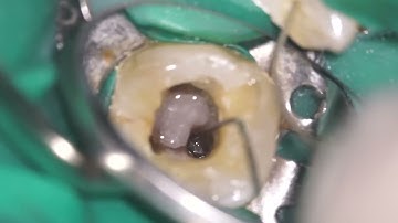 Retrieval of a separated instrument #25 K File with COXO C-FR2 (Time-Lapse)