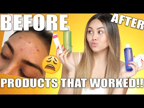HOW I CLEARED MY ACNE | Roxette Arisa