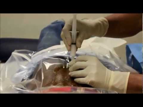 Epidural steroid injections video