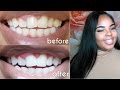 QUICK Way To Whiten Teeth at Home! | + GIVEAWAY &amp; Demo | Smile Brilliant