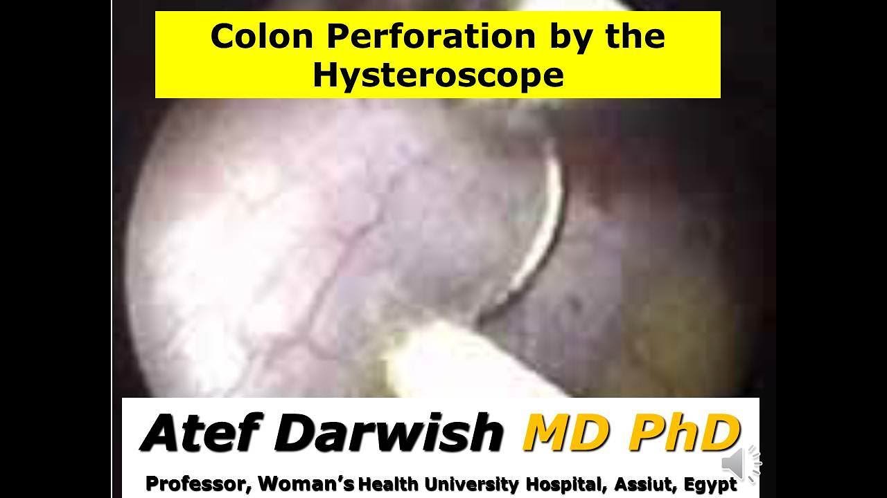 Colon perforation during resectoscopic incision of a uterine septum ...