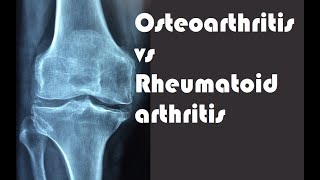 Osteoarthritis And Rheumatoid Arthritis Whats The Difference?