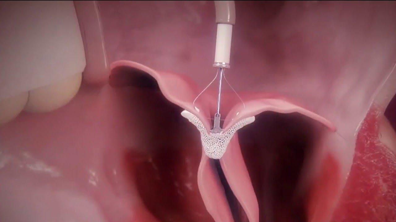 Santé - Cardiologie : une pince pour traiter les valves