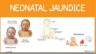 Neonatal Jaundice | Neonatal and Pathologic Jaundice, Causes, Diagnosis and Management  Simplified