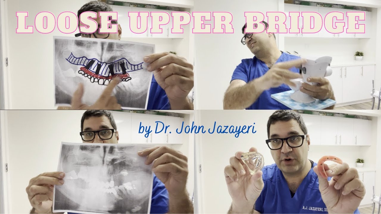 Loose Upper Bridge: Denture? Snap-ons? All-on-4? Full Mouth Implants? Which One?