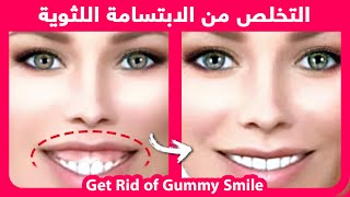 How to naturally get rid of a gummy smile | التخلص من الابتسامة اللثوية