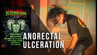 Anorectal Ulceration - Live at Blackblood 13 #SuarKeBachhe