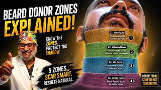 Hair Transplant using Beard and body grafts in Grade 6 Baldness