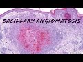 Bacillary Angiomatosis: Dermatopathology Pearls