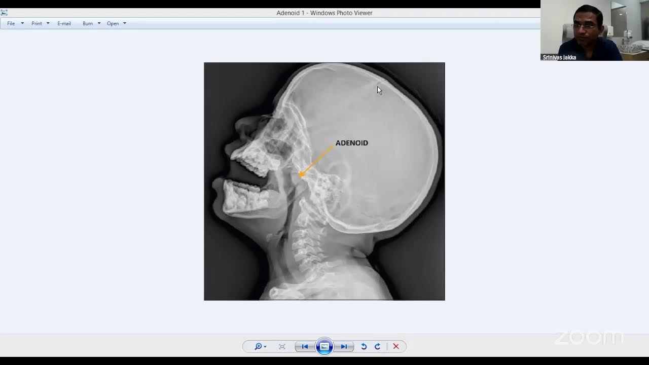 Frequent cold & Cough in Children - Webinar by Dr Srinivas Jakka