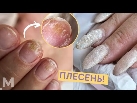 ПЛЕСЕНЬ НА НОГТЯХ: ЛАЙФХАК 😜 СПЛОШНЫЕ ОТСЛОЙКИ и ТРЕЩИНЫ 😱Как лечить плесень под гель лаком.