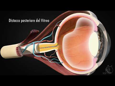 Video: Perché le linee ondulate dopo la vitrectomia?