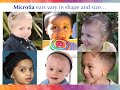 Microtia &amp; Atresia Awareness 2023