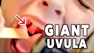 GIANT UVULA! (Bad Throat Infection) | Dr. Paul