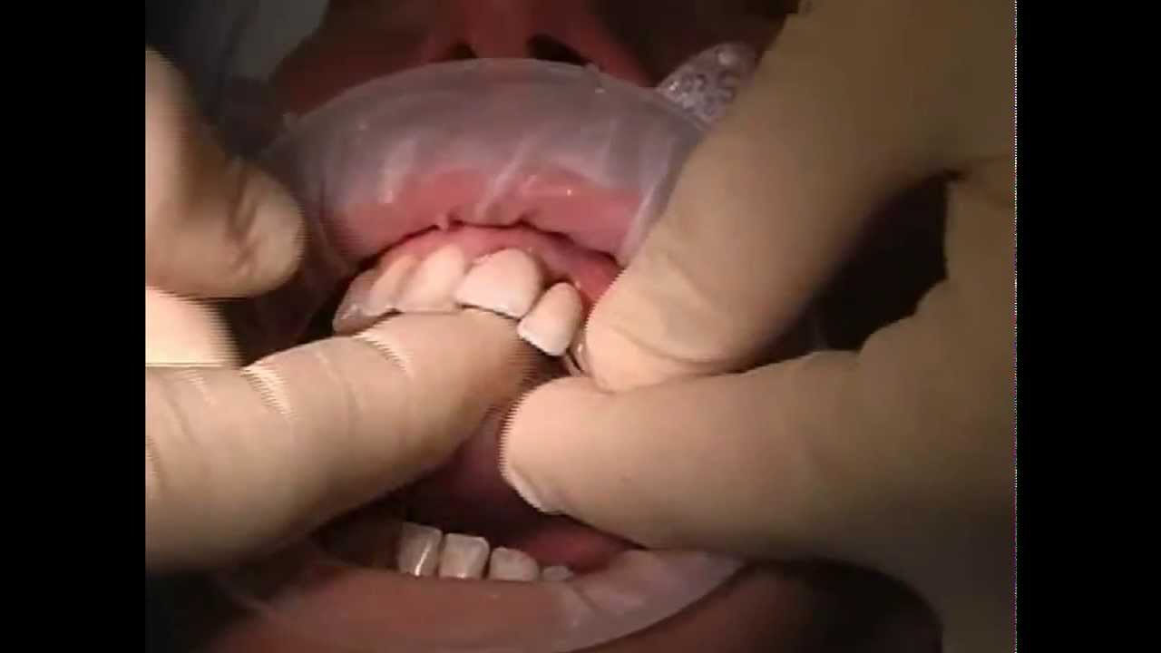 Pontefix Video dimostrazione funzionamento, Cemento provvisorio per corone  dentali, fissare ponti e capsule dentali, colla per denti, come incollare  un ponte dentale, colla per denti provvisori in farmacia