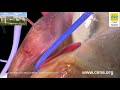 Coronary Artery Bypass Graft CABG (Hindi) - CIMS Hospital