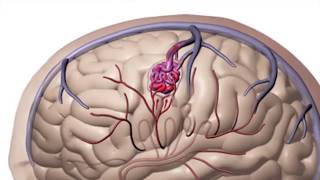 CyberKnife: More Than A Cancer Fighter - Discover Health Episode 17