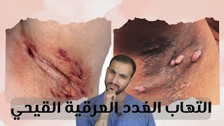 التهابات و خراج بريحة كريهه (التهاب الغدد العرقية القيحي)