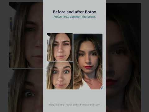 Botox Dr Loukas with before after #dentist #parkridge  #dentalclinic #dentistry