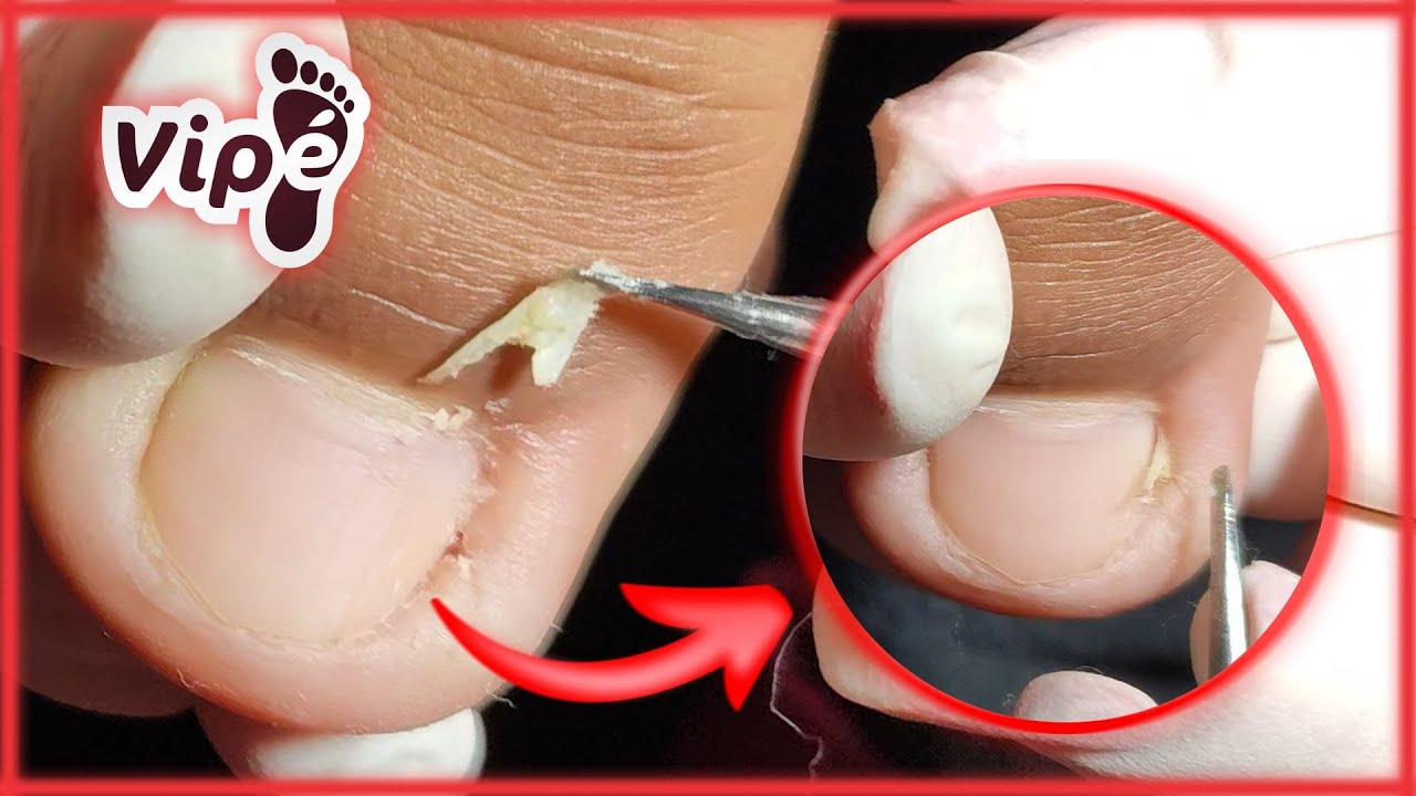 OVERGROWN INFECTED INGROWN TOENAIL REMOVAL YouTube