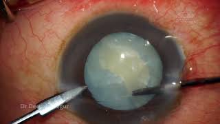 Intumescent Cataract :Dealing with 